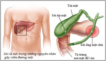 Cholangitis - Hình ảnh minh họa